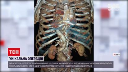 Новости Украины: сосудистые хирурги спасли 74-летнего пациента с зеркальным расположением органов