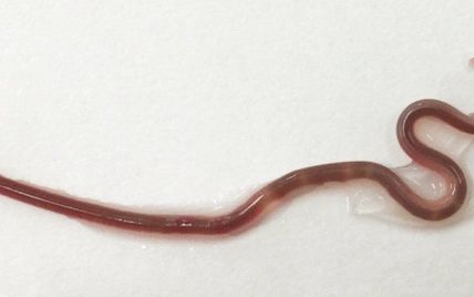 В миндалинах японки после поедания сырой рыбы поселился круглый червь