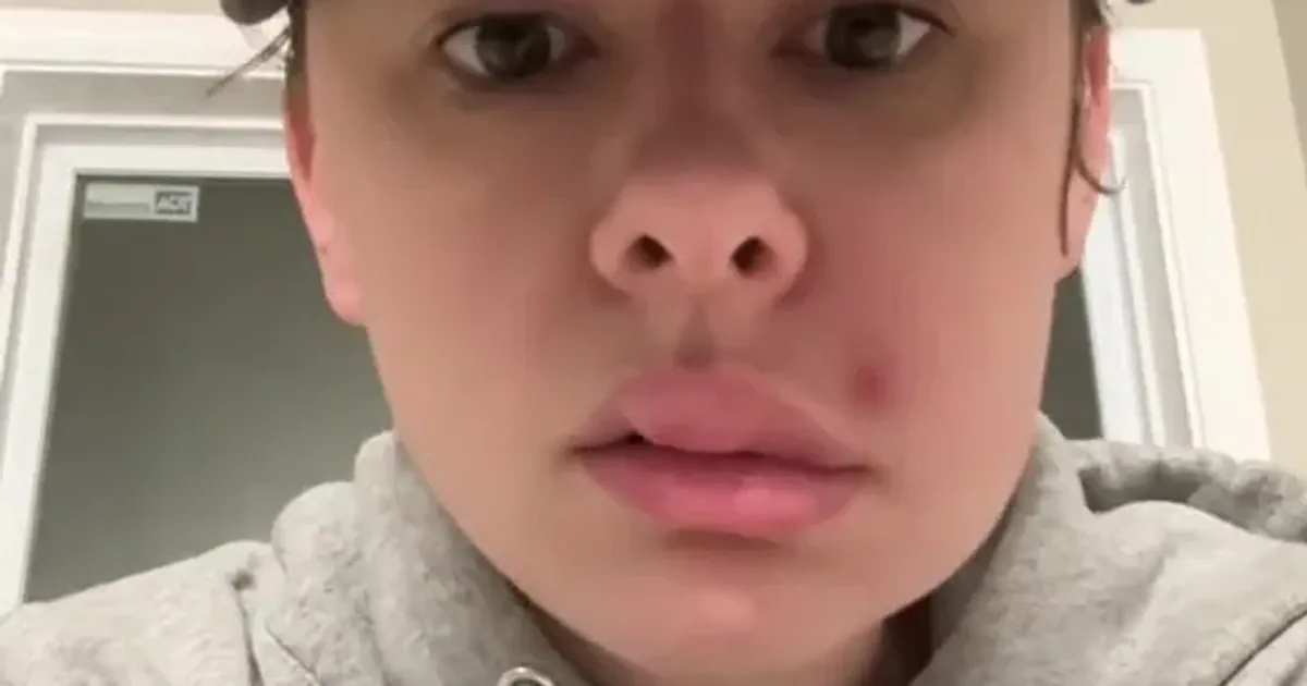 Обличчя жнки після видавлення прищу. Фото: neverdulldeos1/Tiktok