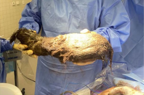 Волосы из желудка ребенка / Фото: Journal of Pediatric Surgery Case Reports