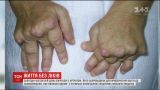 Больные ревматоидным полиартритом потеряли шанс на излечение за счет государства