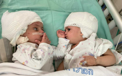 В Израиле впервые разделили соединенных головами близнецов: трогательное видео первой встречи сестер