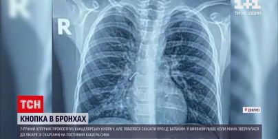 Новини Дніпра: лікарі врятували 7-річного хлопчика, у бронхах якого була металева кнопка