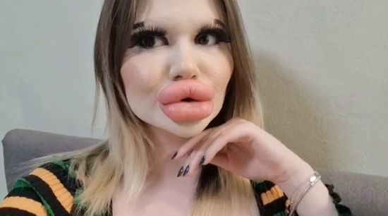 Жінка з найбільшими губами у світі вирішила змінити ще одну частину обличчя: який вона має вигляд