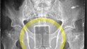 Фермер засунул банку с химикатом в анус / Фото: Science Direct