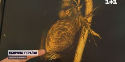 Лікарі столичної лікарні "Феофанія" дістали кулю із серця українського військового