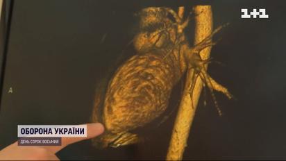 Врачи столичной больницы "Феофания" достали пулю из сердца украинского военного