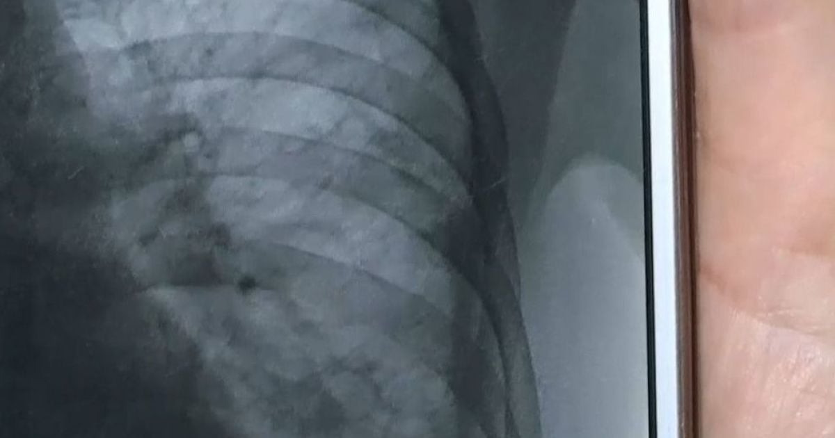 Загадкова пневмонія в Україні у січні змусила задуматись українців про спалах коронавірусу вже тоді