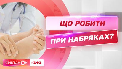 Що робити при набряках влітку? Поради лікаря-флеболога