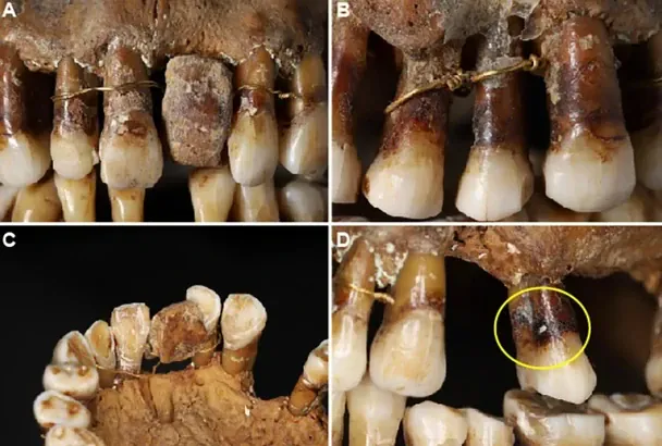 Зуби Анни Анни д’Алегр. Фото: Colleter et al., J. Archaeol. Sci. Rep. , 2023