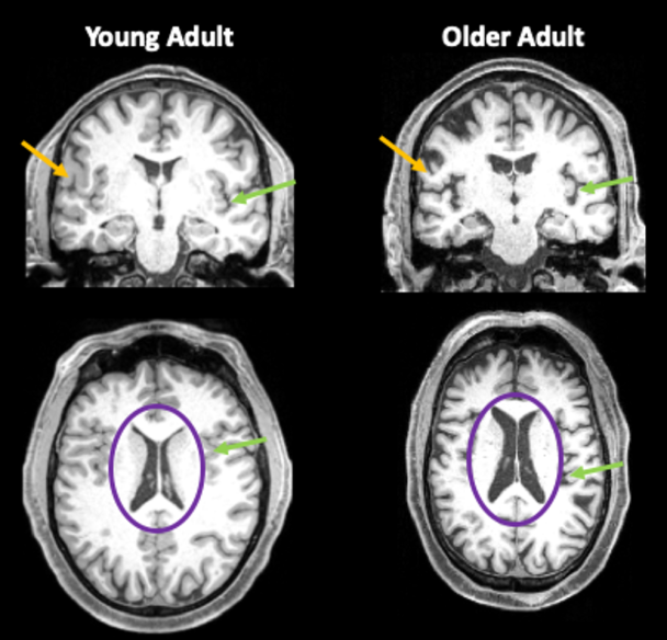 Сканування мозку у людини у 30 років та у людини у віці 80 років, що показує зменшення об’єму мозку у мозку старшого дорослого / © 