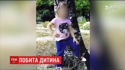 4-летняя девочка, подвергшаяся дома тяжелым травмам, до сих пор на грани жизни и смерти