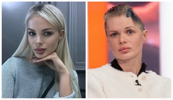 Російська модель втратила пів черепа через побиття бізнесменом: чоловік помер від страху (фото)