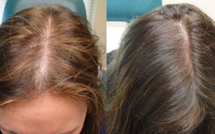 Выпадение волос: как решить проблему, подобрать витамины и уход | РБК Стиль