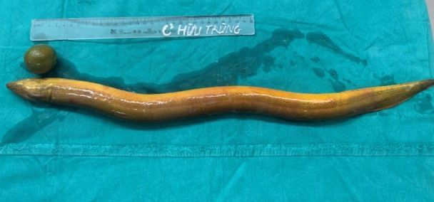 Із кишківника чоловіка дістали живого вугра / Фото: Dantri Із кишківника чоловіка дістали живого вугра / Фото: Dantri