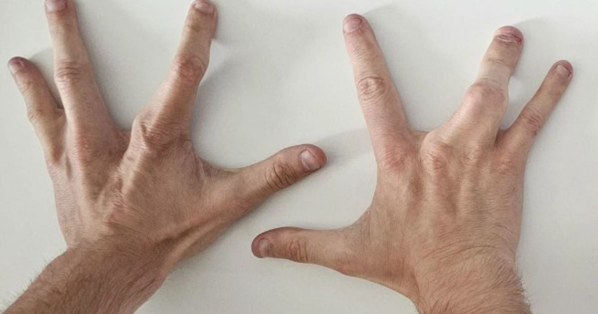 Чоловік із 8 пальцями