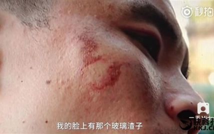 Китаєць показав наслідки вибуху в руках iPhone 7