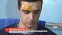 Електронна сигарета вибухнула в руках 18-річного хлопця