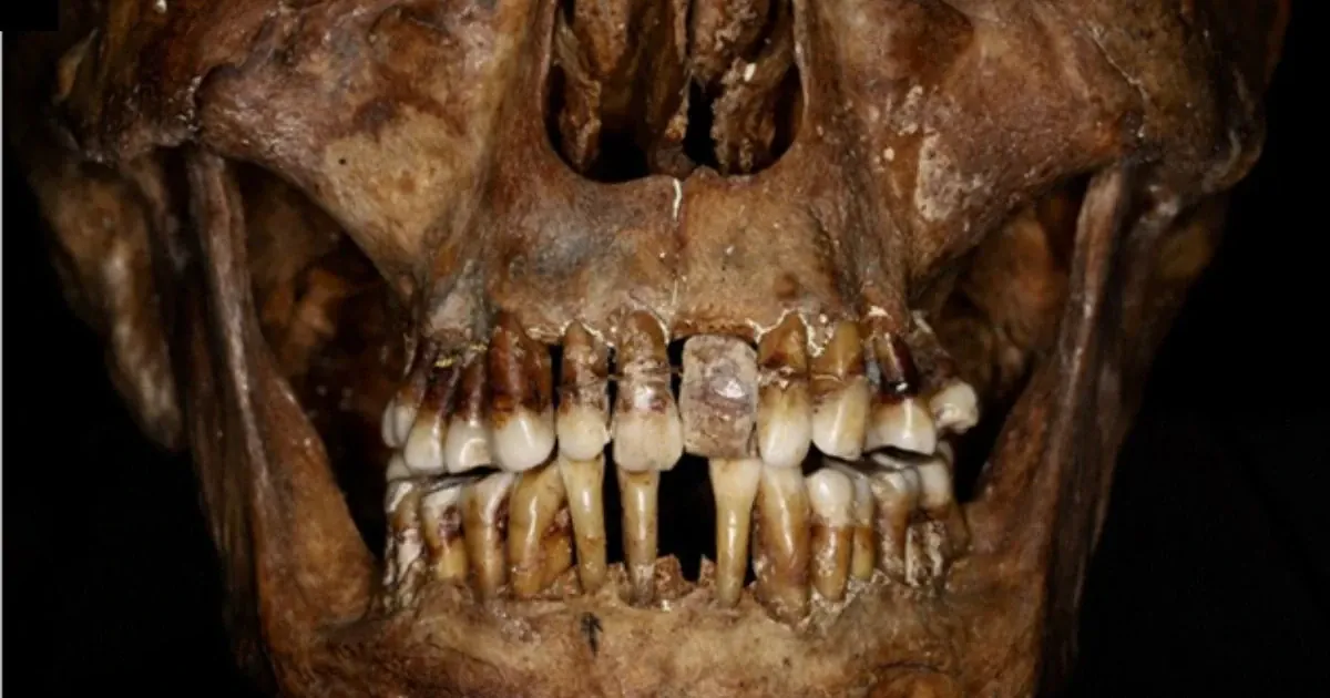 Зуби Анни Анни д'Алегр. Фото: Colleter et al., J. Archaeol. Sci. Rep. , 2023