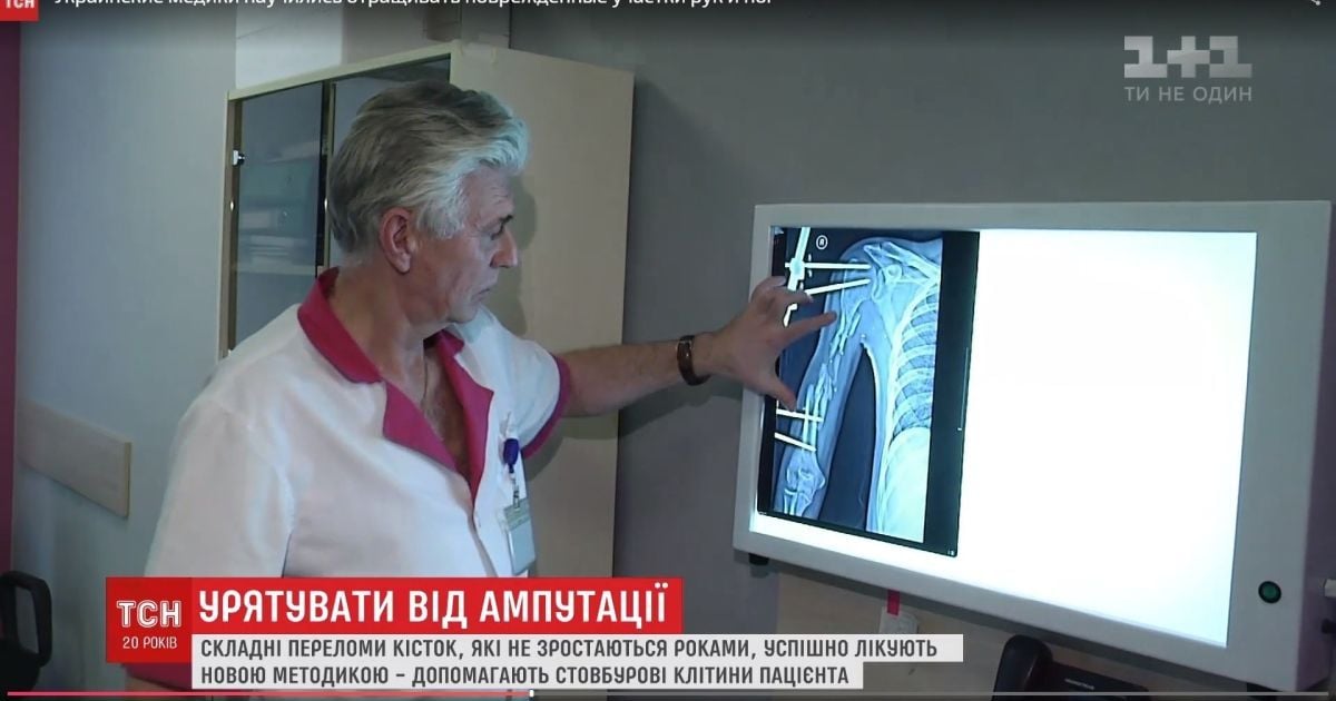 Український лікар навчився вирощувати кістки для поранених вояків АТО