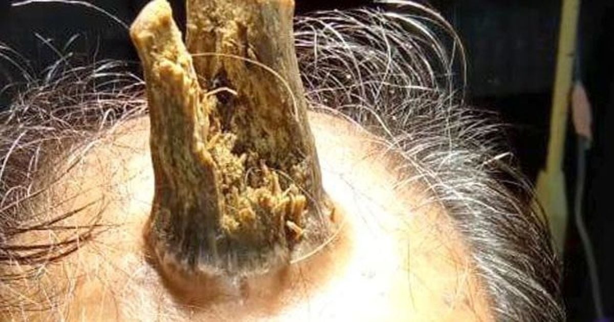 Індійцеві спиляли 10-сантиметровий ріг, який виріс просто на маківці