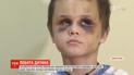 Фиолетовый от гематом: в Винницкой области жестоко избили 6-летнего мальчика