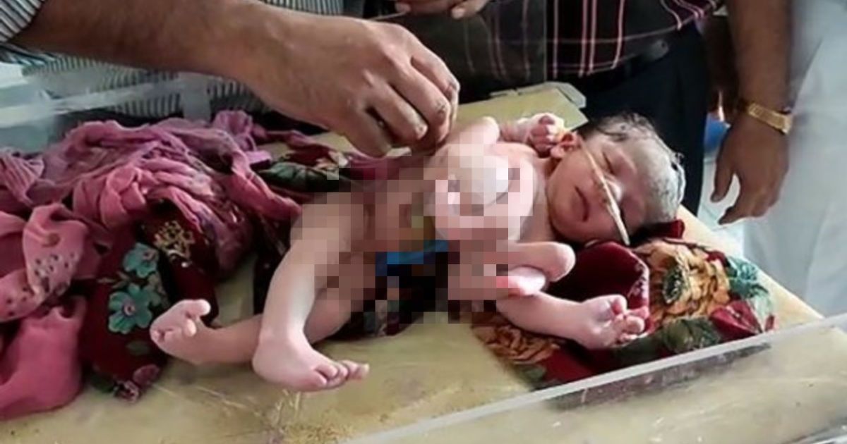 Считают божеством: в Индии родился младенец с четырьмя руками и ногами (фото)