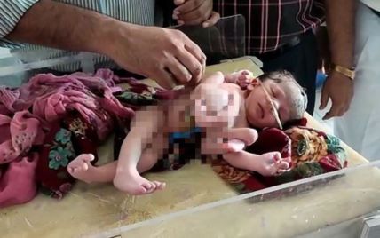 Считают божеством: в Индии родился младенец с четырьмя руками и ногами (фото)