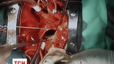 Українські хірурги вчаться у європейських оперувати серце, не розтинаючи грудей