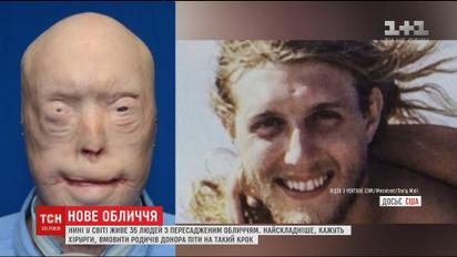 В Україні десятки людей потребують пересадки обличчя, яка заборонена законодавчо