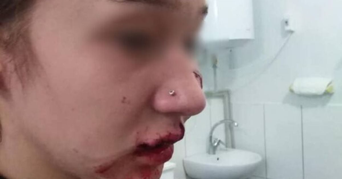 Все лицо было в крови: под Днепром домашняя собака напала на 14-летнюю девушку