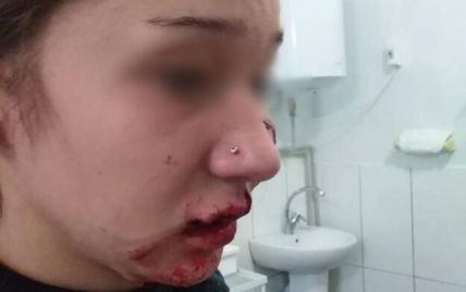 Все лицо было в крови: под Днепром домашняя собака напала на 14-летнюю девушку