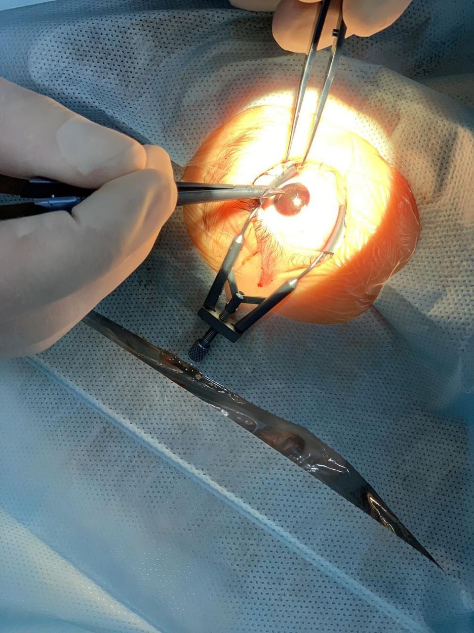 Лікар-офтальмолог провів одномоментну мікрохірургічну обробку проникного поранення з вправленням райдужки і накладенням мікрошвів.