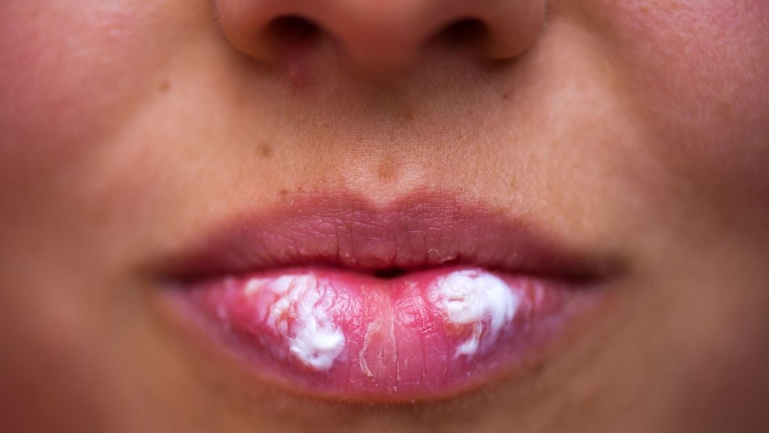 Как лечить хейлит на губах: что это такое
