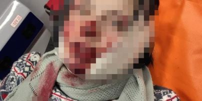 В Киеве сожитель набросился с ножом на женщину и порезал лицо