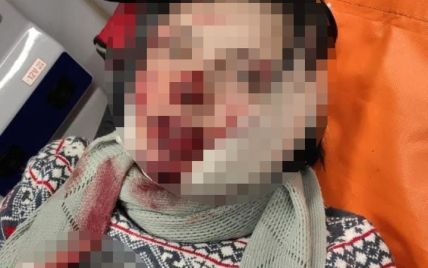 У Києві співмешканець накинувся з ножем на жінку та порізав їй обличчя