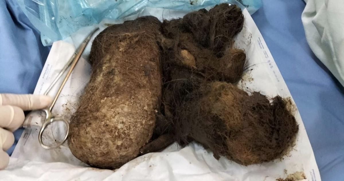 Во Львове из желудка девушки удалили килограмм волос/Фото: Центр детской медицины больницы "Охматдет"