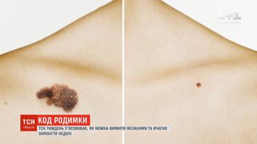 Як уникнути меланоми і розпізнати підозрілі родимки на тілі – ТСН.Тиждень порадить