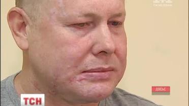 Звільненому з полону волонтерові Володимиру Жемчугову рятуватимуть зір в Німеччині