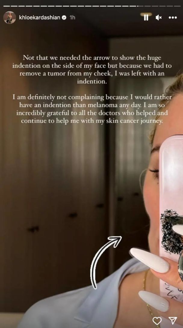 Хлоя Кардашьян появилась после удаления меланомы. / © instagram.com/khloekardashian