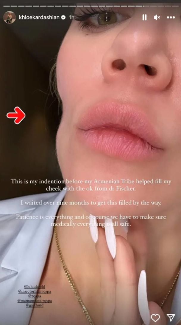 Хлоя Кардашьян появилась после удаления меланомы. / © instagram.com/khloekardashian