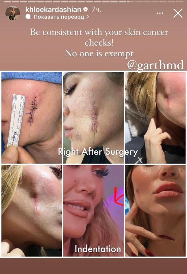 Хлоэ Кардашян показалась после удаления меланомы. / © instagram.com/khloekardashian