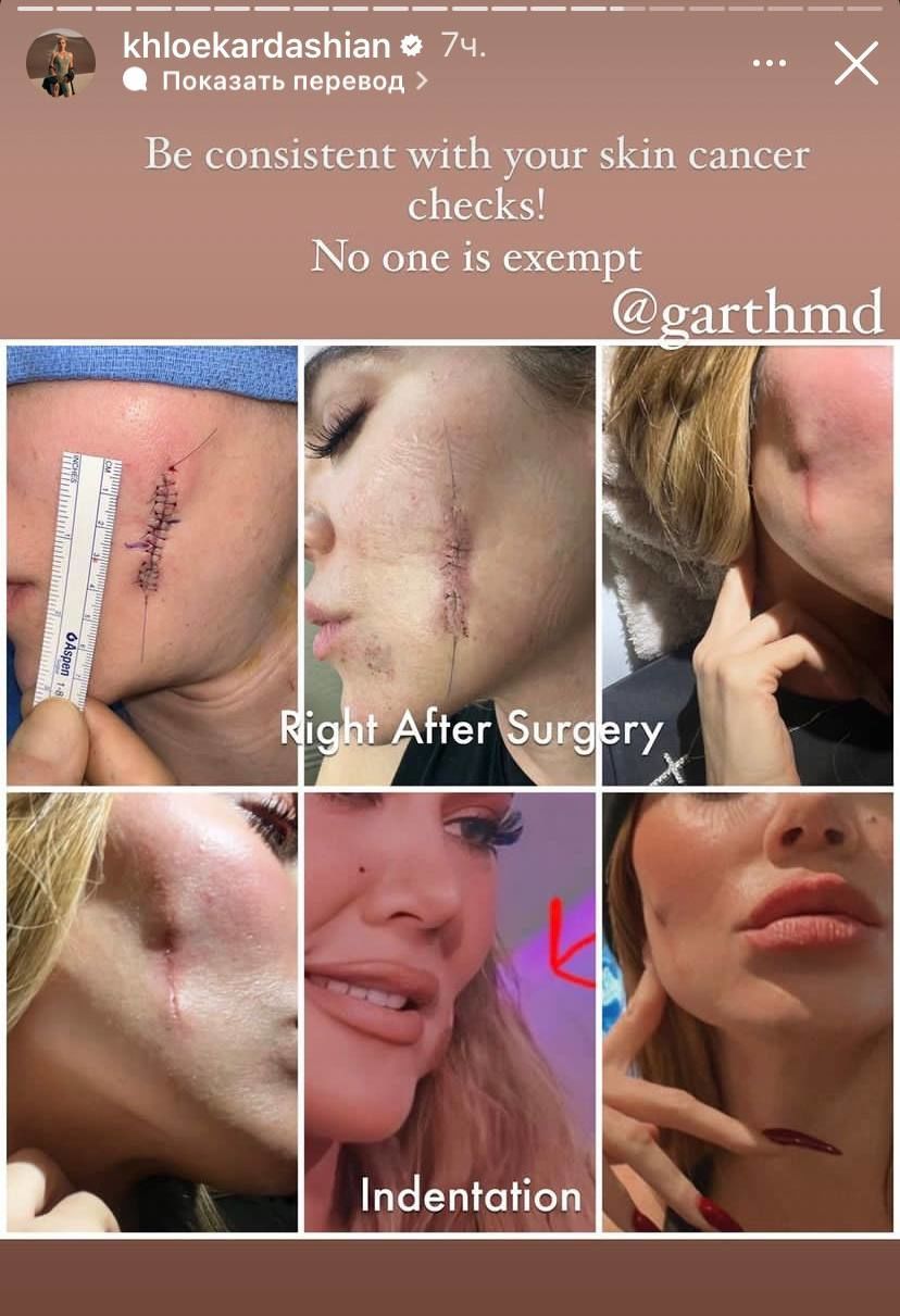 Хлоя Кардашьян появилась после удаления меланомы. / © instagram.com/khloekardashian