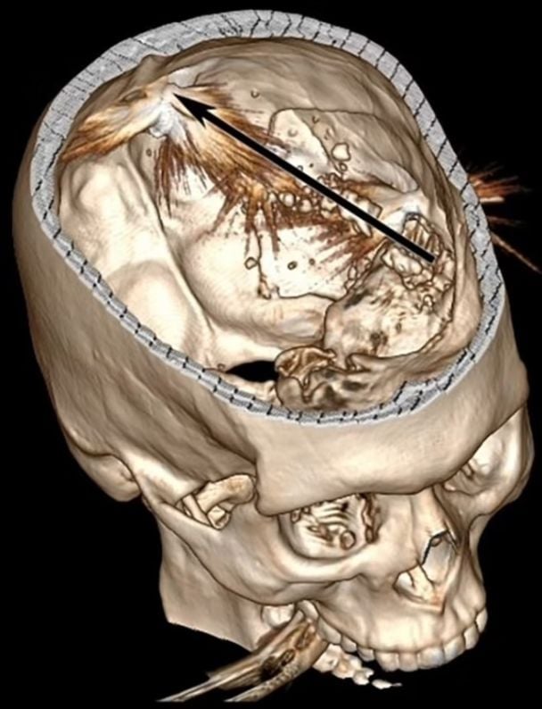 Скан черепа постраждалого фермера / Фото: American Journal of Case Reports/ISI / © 