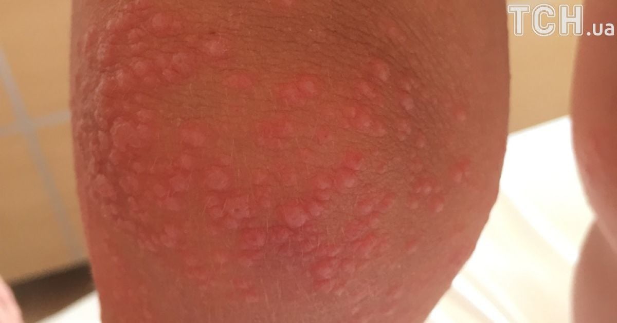 вірус коксакі_2