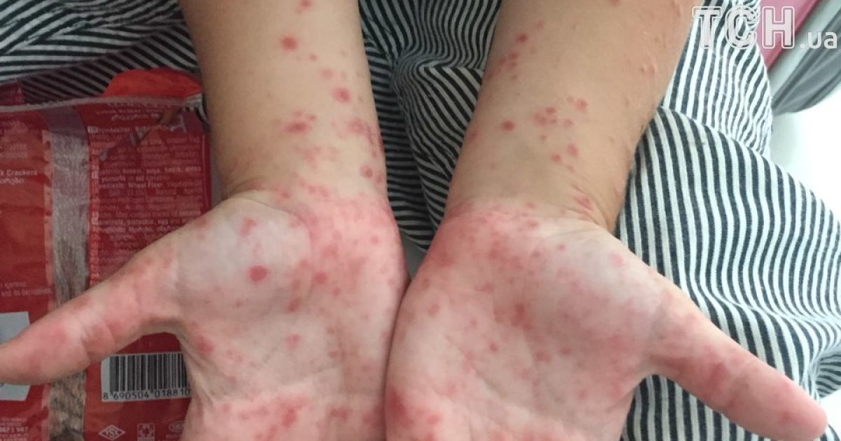 вірус коксакі_5