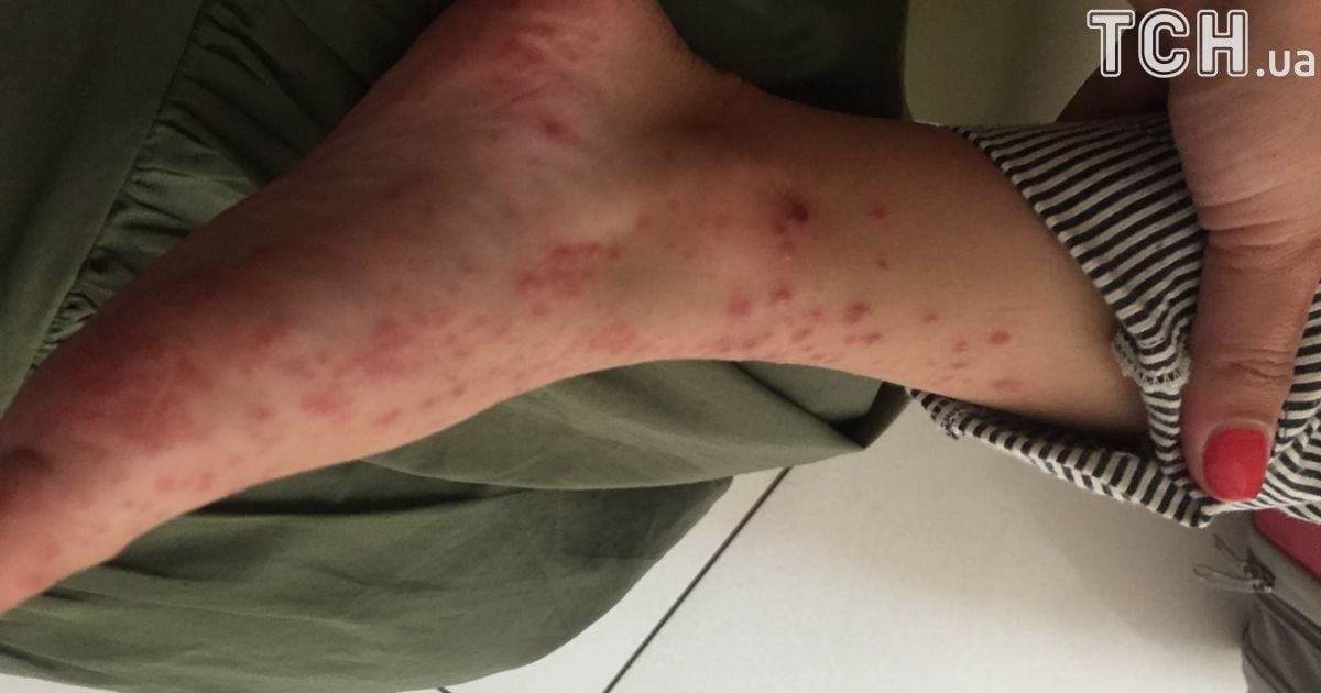 вірус коксакі_3