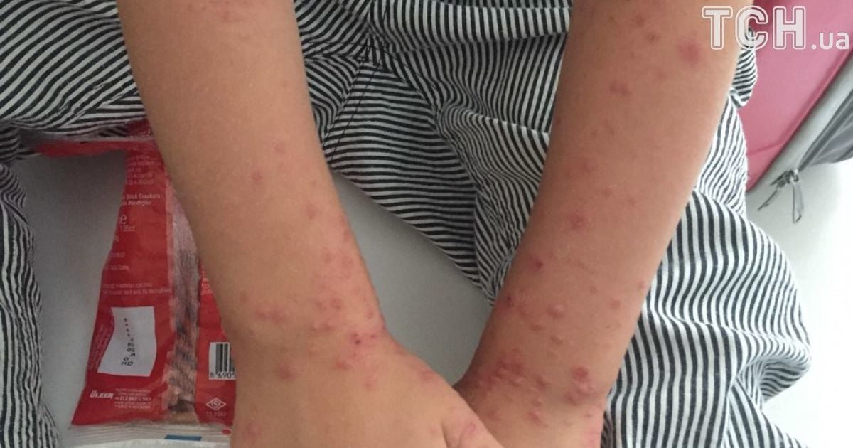 вірус коксакі_4