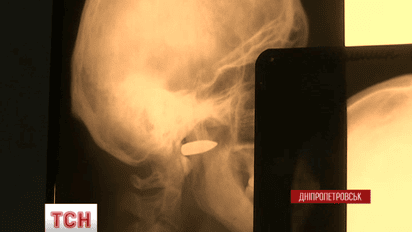 В Днепропетровскую областную больницу доставили восемь тяжелораненых бойцов