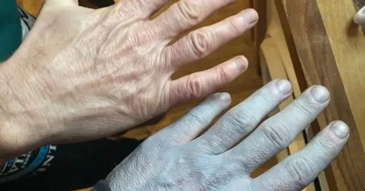 Поседела рука. Фото: Томми Линч / SWNS